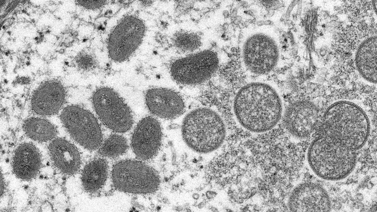 Americana registra primeiro caso suspeito de varíola dos macacos