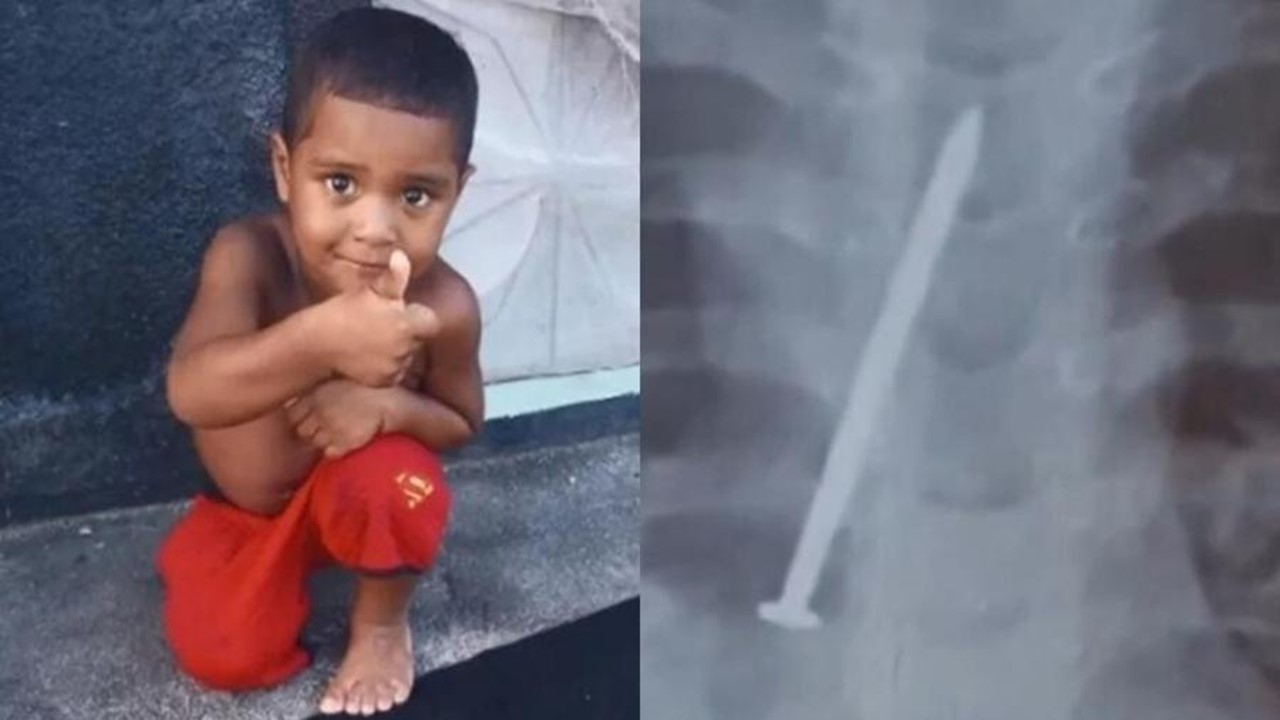 Menino de três anos morre com prego no pulmão