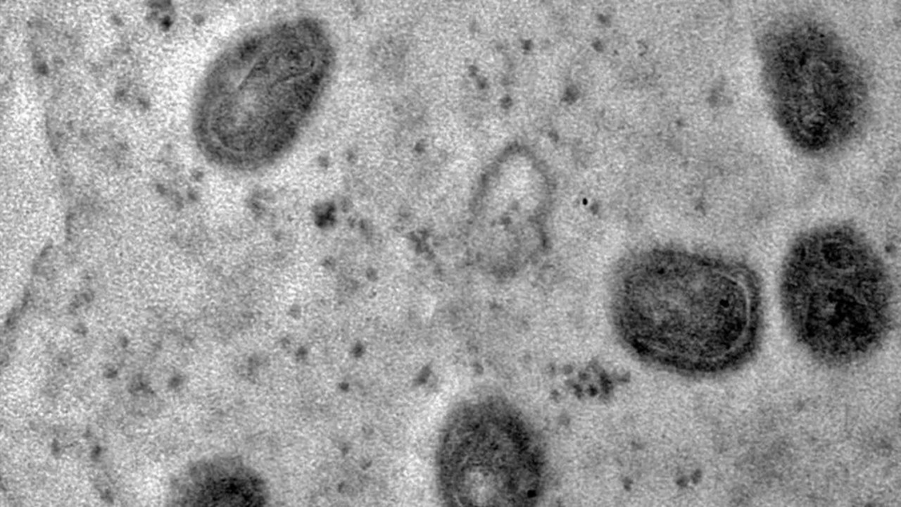 Limeira tem oito casos confirmados de varíola dos macacos
