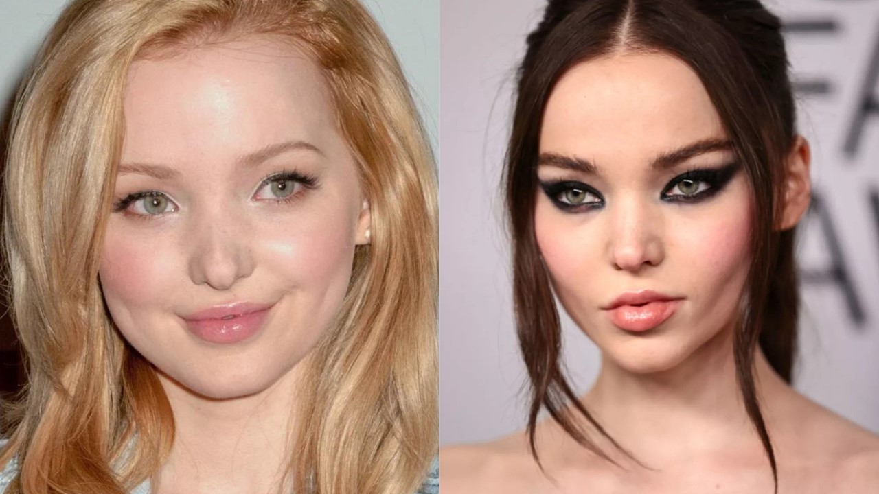 Buccal Fat Removal Dove Cameron