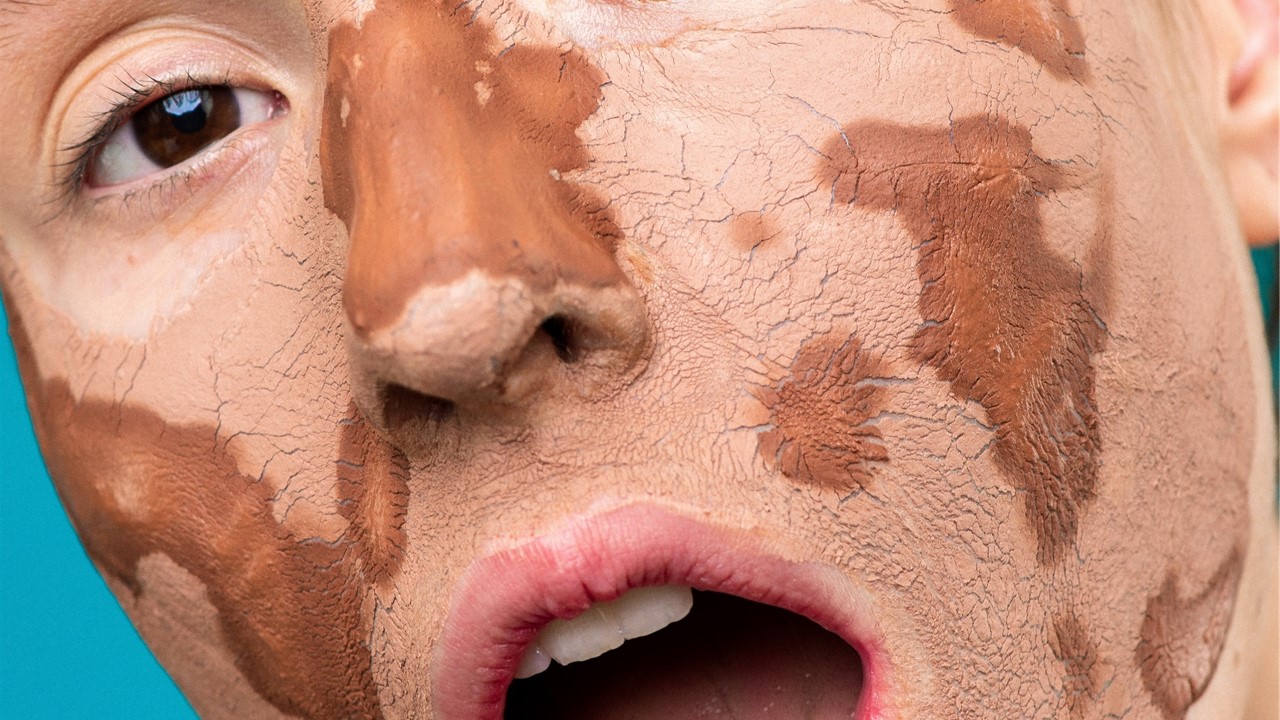 Doenças de pele podem piorar com o estresse, diz pesquisa