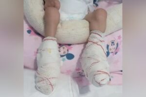 Morre bebê de oito meses que teve os pés queimados por aquecedor em hospital