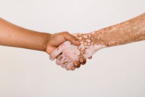 Dia Mundial do Vitiligo preconceito é a maior luta a ser enfrentada pelos pacientes, destaca especialista