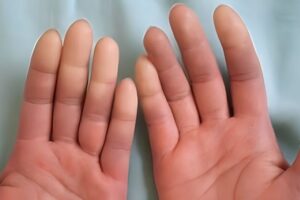 Esclerose Sistêmica Alteração da cor nas extremidades das mãos e pés, conhecida como fenômeno de Raynaud, é um dos sintomas frequentes. O reumatologista é o especialista que trata esta doença