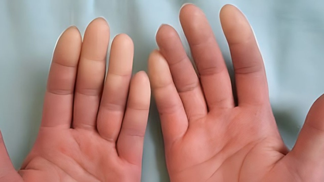 Esclerose Sistêmica Alteração da cor nas extremidades das mãos e pés, conhecida como fenômeno de Raynaud, é um dos sintomas frequentes. O reumatologista é o especialista que trata esta doença